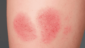 Alergia – objawy i leczenie.