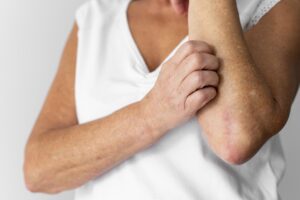 Dermatozojalny urojeniowy (zespół Ekboma) – leczenie urojeń dotyczących skóry